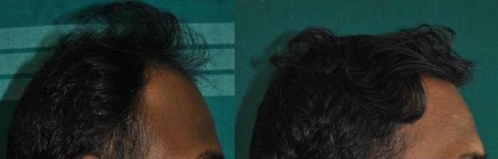 Hair MegaSpray: reseñas reales de hombres, especialistas