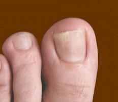 ¿Es eficaz la pomada del hongo de las uñas en las piernas?
