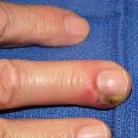 En el dedo del panaritium. El tratamiento en casa es posible?