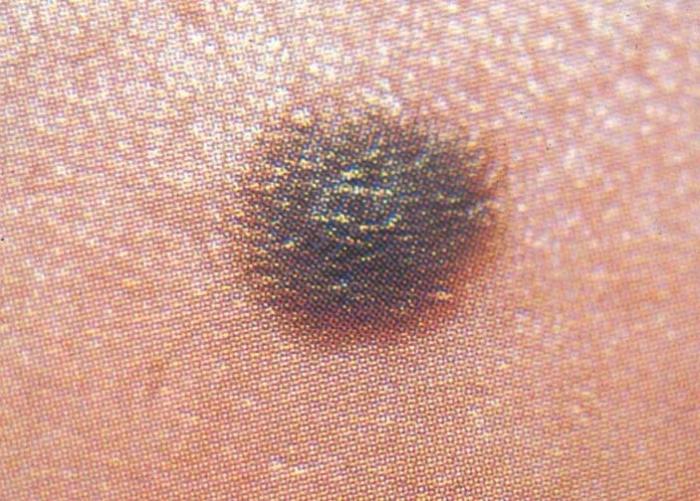 Los principales signos del melanoma y las causas del melanoma