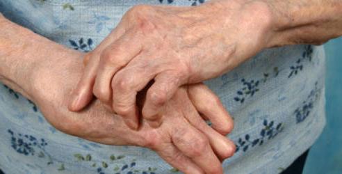 diagnóstico de la artritis reumatoide