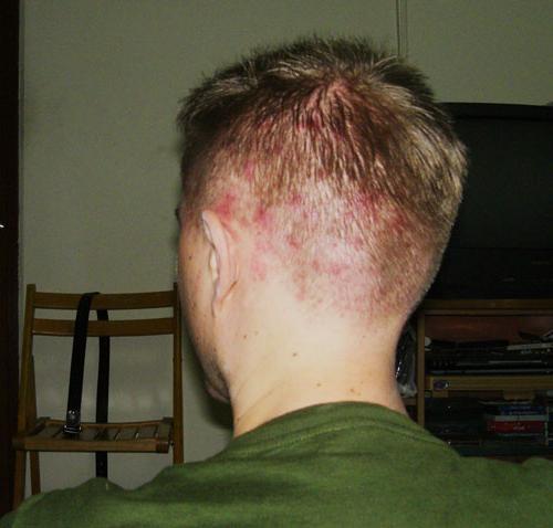 Acné en la cabeza debajo del cabello: las causas del aspecto y las características del tratamiento